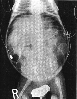 Fig.  1.  Infantogram  at  admission  shows  multiple  dilatation  of  bowel  loops  in  the  abdomen