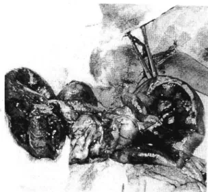 Fig.  1.  Upper  gastrointestinal  series  of  Case  1  shows  abrupt  interruption  of  dye  passage  at   proxi-mal  jejunum,  but  gaseous  distention  in  the  other  loops  indicates  partial  obstruction