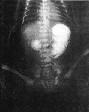 Fig.  1.  Plain  abdomen  shows  double-bubble  sign  and  absence  of  gas  shadow  in  the  distal  bowel