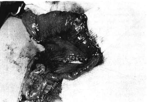 Fig.  2.  This  photo  shows  completed  end  to  end,  single layer anastomosis  using  5-0  Vicryl  sutures