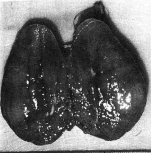 Fig.  1.  This  photo  shows  enlarged  penis (7  cm  in  length),  testicles( 4ml  in  volume)  and  scanty  pubic  hairs were  also noted