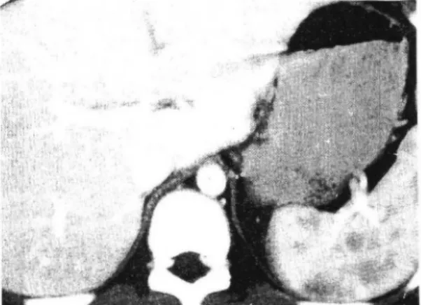 Fig.  1.  Sonogram  shows  multiple  hypoechoic  lesions  all  over  the  spleen  with  slight  irregular  margins