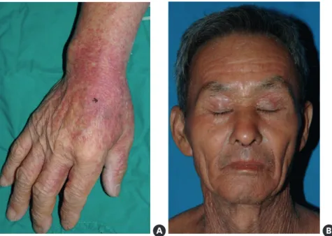Fig. 2. Skin symptoms of DRESS syndrome vary and include the following: disuse infiltrative maculopapules,  exfoliation, facial edema and urticaria
