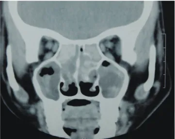 Fig. 5. Computed tomography of the paranasal sinuses showing hyperdense le- le-sions in the ethmoid and maxillary sinuses bilaterally, suggestive of inspissated  secretions.