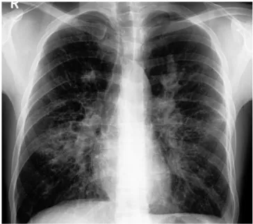 Fig. 2. Plain chest roentgenogram of the same patient taken 4 months later  showing spontaneous resolution of the left-sided perihilar opacity