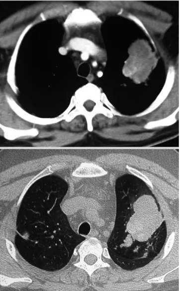Fig. 4. High resolution computed tomography of the thorax (mediastinal win- win-dow and corresponding section on the lung winwin-dow) showing high attenuation  mucous (HAM) impaction.