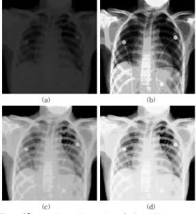 Fig.  6은  낮은  명암대비를  갖는  "Chest  X-ray"  영상에  대해  기존의  방법과  제안한  알고리즘을  적용한  결과를  나타낸  것이다
