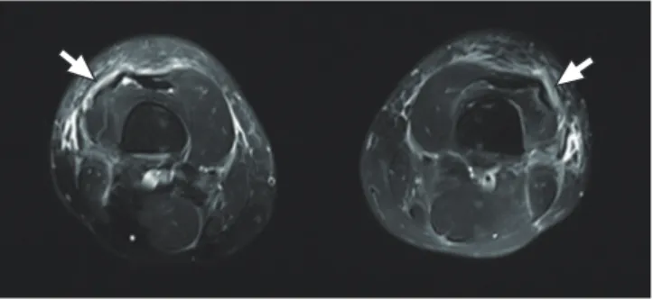 Fig. 2.  Perivascular eosinophilic infiltration in deep dermal and subcutaneous  fat tissue (×400).