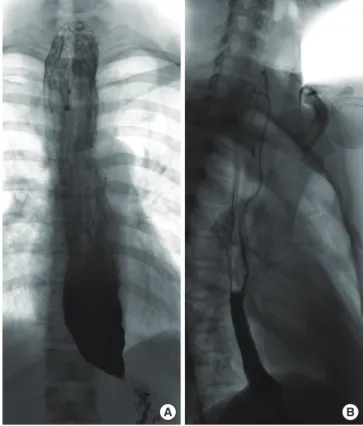 Fig. 3. Esophagography shows the typical beaking appearance of the esophago- esophago-gastric junction and dilatation of the proximal esophagus (A)