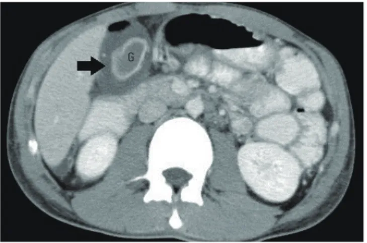 Fig. 1.  Acalculous cholecystitis with pericholecystic fluid collection as demon- demon-strated by abdominal computed tomography scans