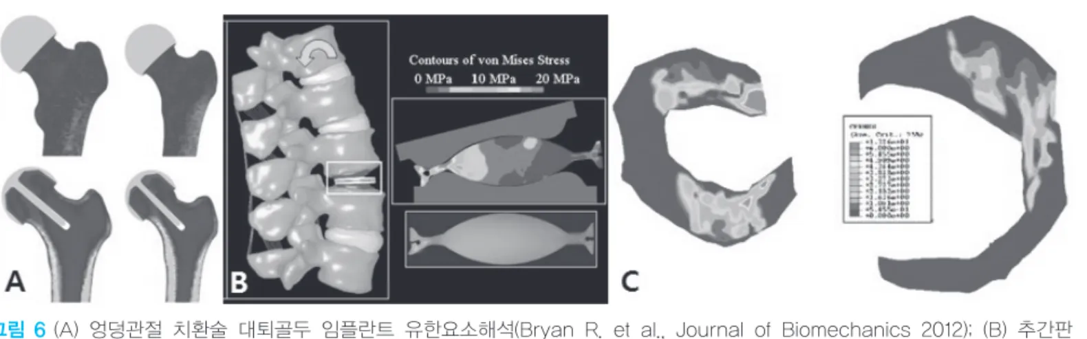 그림 6 (A) 엉덩관절 치환술 대퇴골두 임플란트 유한요소해석(Bryan R. et al., Journal of Biomechanics 2012); (B) 추간판 응력 해석(http://www.exponent.com);  (C)  반월상연골 접촉 압력 분석(Pen~ a  E  et  al.,  Journal  of  Biomechanics 2006)