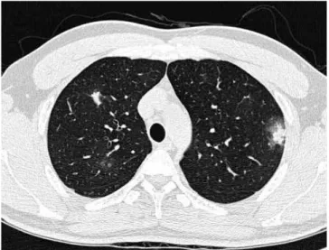 Fig. 3.  Patchy and dense eosinophilic infiltration in liver biopsy (H&amp;E stain, A: ×200, B: ×400).