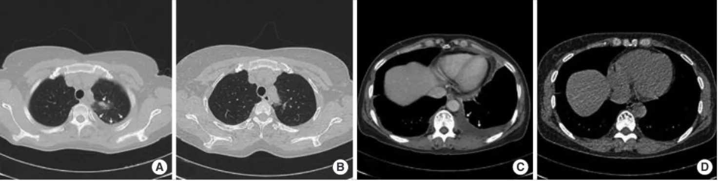 Fig. 3. Axial computed tomography (CT) scans reveal a focal area of consolidation containing tiny nodules in the upper left lobe (arrow) at the pulmonary window set- set-ting (A) and left pleural effusion (arrow) at the mediastinal window setset-ting (C)