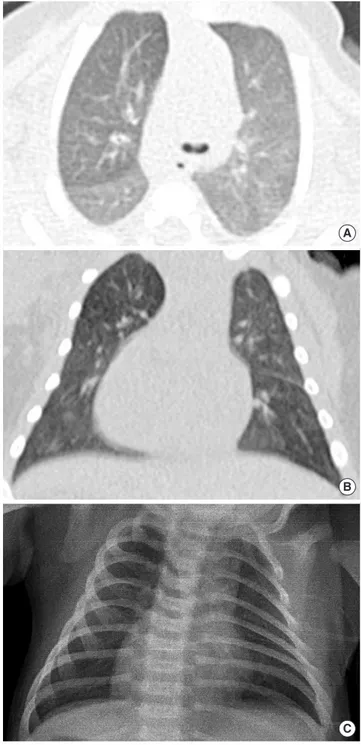 Fig. 1. Chest X-ray on admission (the third day of birth) shows dextrocardia and  hyperinflated lungs.