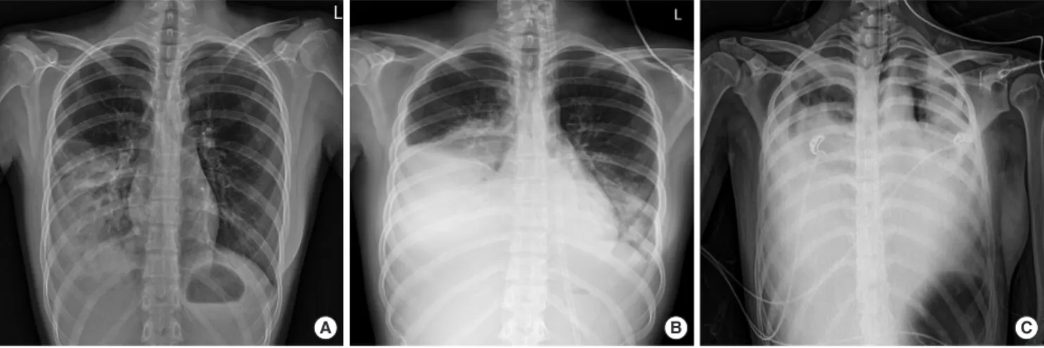 Fig. 2. (A, B) Chest computed tomography (CT) scan findings of case 1. (A) Chest  CT, on the 5th hospital day, shows pneumonic consolidations in both lung and  bilateral moderate amount of pleural effusion