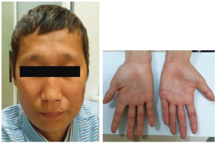 Fig. 3. Nearly complete resolution of the previous rash and alopecia was noted  at 1 year later.Serum zinc (μg/dL)80604020