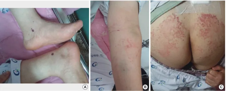 Fig. 1. Multiple purpuric papules are observed on both ankles (A), left forearm (B), and buttock (C).