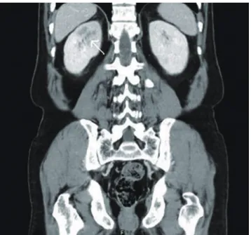 Fig. 3. The glomerulus of kidney biopsy reveals crescentic glomerulonephritis (A), and skin biopsy is consistent with leukocytoclastic vasculitis (B, C)