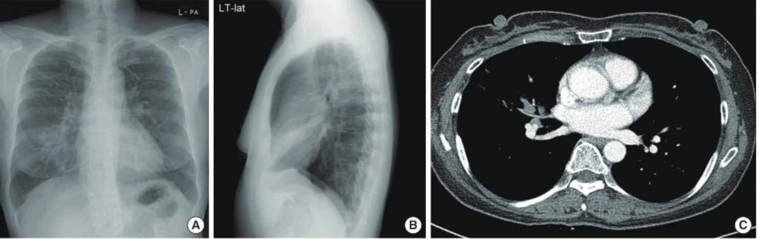Fig. 1. (A, B) Chest X-ray shows consolidation in right middle lobe. (C) Chest computed to-mography shows soft tissue density obstructing right middle lobe bronchus.