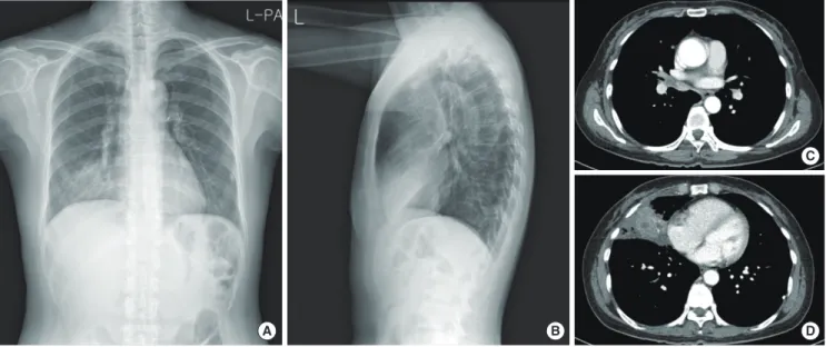 Fig. 3. (A, B) Chest X-ray shows consolidation in right middle lobe (RML). (C) Chest computed tomography shows an endobronchial lesion obstructing RML medial  segmental bronchus and (D) lobar consolidation with internal low attenuated lesion in RML.