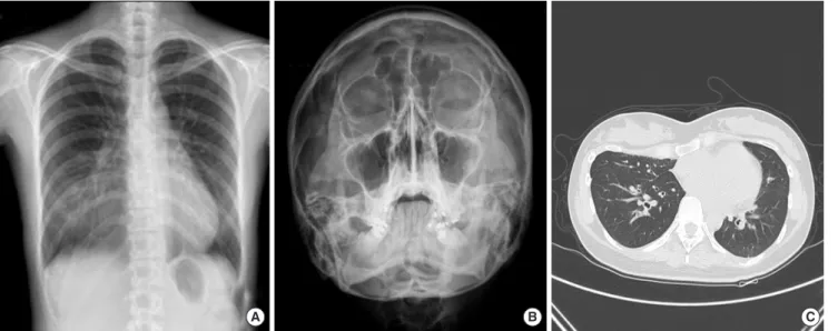 Fig. 1. (A) Chest X-ray shows increased opacity in right lower lung field, probably due to pectus excavatum