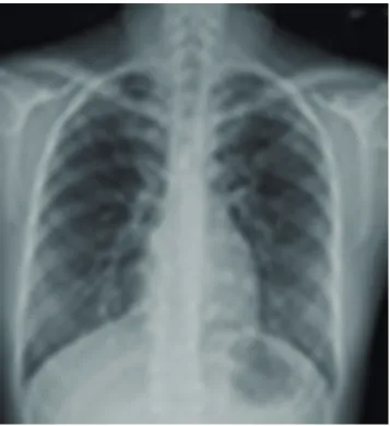 Fig. 2. The initial high resolution computed tomography revealing patchy and extensive ground-grass opacity lesions with crazy-paving appearance especially in the  upper (A) and middle (B) lung zone.