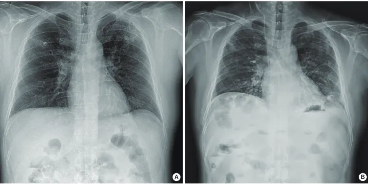 Fig. 1. (A) Initial chest radiograph shows bilateral ground glass opacities in both upper lung fields