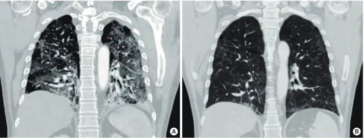 Fig. 2. (A) Coronal reformatted computed tomography image obtained five days after the initial chest radiograph