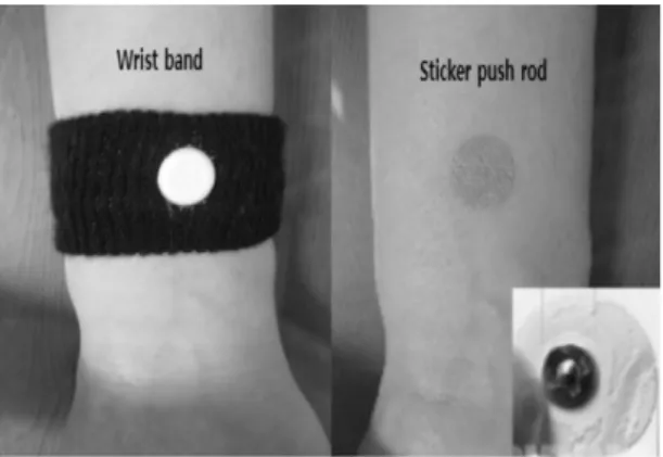 Figure  2.  Nei-guan  acupressure  tool∙ 대조군  :  활력  징후와  섭취  배설량  측정과  같은  일상적인 수술  후  간호를  제공하였다.∙ 손목밴드군 :  수술  당일  연구자는  정맥로가  확보되지  않은 대상자  손목의  내관  지압점에  유성펜으로  표시하였다