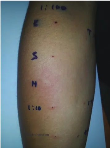 Table 1. Results of skin prick test and challenge test for suspected drugs