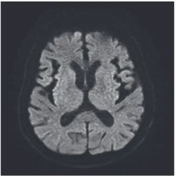 Fig. 2. The initial electroencephalography showed the triphasic nonconvulsive ictal wave (A), and the electroencephalography became normal shape without triphasic  wave after discontinuance of cefepime (B)