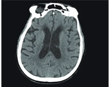 Fig. 1. Chest computed tomography shows pleural effusion.