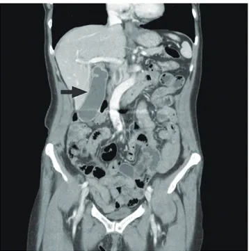 Fig. 2. Pathology of gallbladder shows necrotizing vasculitis with fibrinoid ne- ne-crosis (A, arrow) and necrotizing granuloma centered on necrotic eosinophils (B,   arrow)