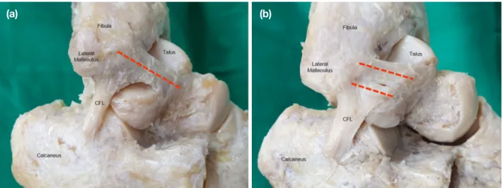 Table 3. Comparison of male and female feet according ATFL type