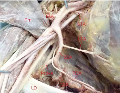Fig. 2. An example of the variations of pattern and origin of subscapular artery (SSA) from axillary artery