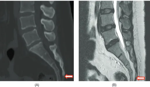 Fig. 1. Determination of the exact measurement of position in relation to the location and the type of variation of the sacral hiatus (SH): (A)  Identification of the position of SH using bone setting sagittal images with CT, and (B) Determination of the e