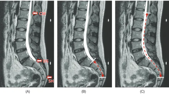 Fig. 3. MRI T2-weighted, midsagittal plane images using PACS (picture archiving communication system) were measured along the ver- ver-tebral canal: (A) The position of the sacral hiatus (SH), termination of dural sac (DS) and conus medullaris (CM)