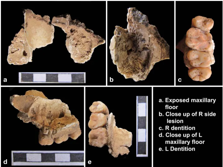 Fig. 6. Kodumanal, Trench ZJ 26, Spe. II: (Male, Around 20 years), Lobules bone changes on R maxilla floor.