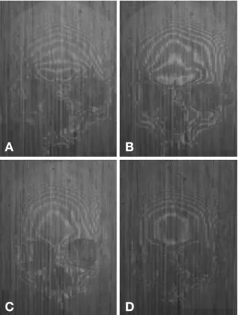 Fig. 3. From the frontal view. (A) Reverse triangle, (B) Triangle over reverse triangle, (C) Diamond, (D) Home plate.