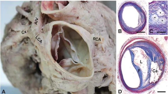 Fig. 1. Macroscopic (A) and microscopic (B-D) features of the coronary artery. Right coronary artery (RCA) was considered as hypoplastic (A), but turned out to be normal (B)
