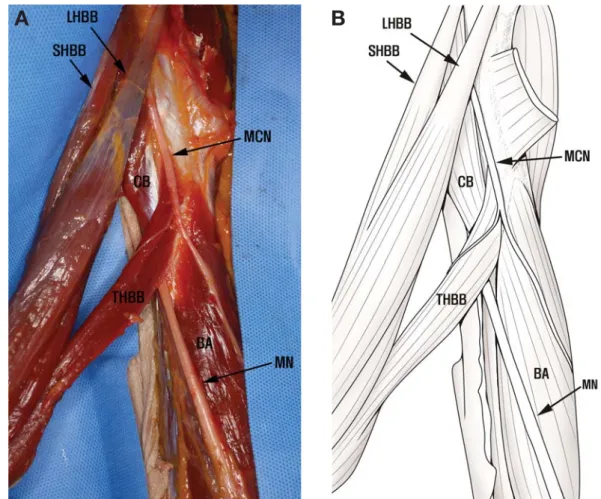 Fig. 1. The third head of the biceps brachii. The distal part of the biceps brachii is detached from the bone to show the third head