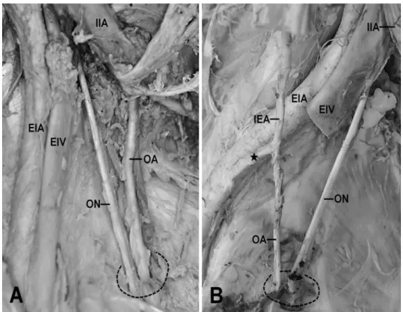Fig. 1. The origin of the obturator artery. A: Normal obturator artery (OA) originating from the internal iliac artery (IIA) on the right side of pelvis in a male (73 years of age)
