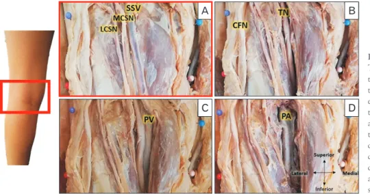 Fig. 1. The dissected left popliteal fossa. 