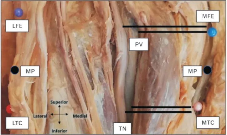 Fig. 5. The PA was measured from the MFE, MTC and the MP  between these landmarks. LFE, lateral most point of the lateral  epicondyle of the femur; LTC, lateral most point of the lateral condyle  of the tibia; MFE, medial most point of the medial epicondyl
