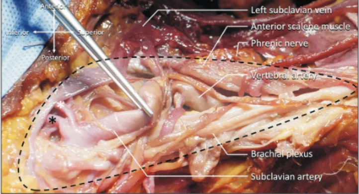 Fig. 1. Left scalene triangle (dotted line). Note the medial (white asterisk)  and lateral (black asterisk) branches of the internal thoracic artery.