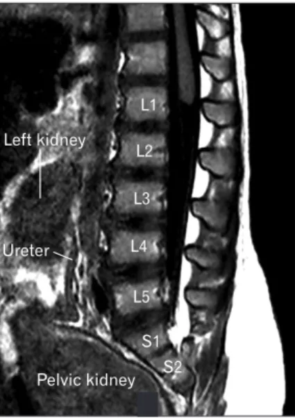Fig. 2. T1-weighted sagittal magnetic resonance imaging. Note the  lower left kidney located in the midline with the ureter posteriorly  and a large pelvic kidney