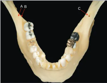 Fig. 1. A dry mandible demonstrating double retromolar foramina on  the right (A, B) and a retromolar foramen on the left (C)