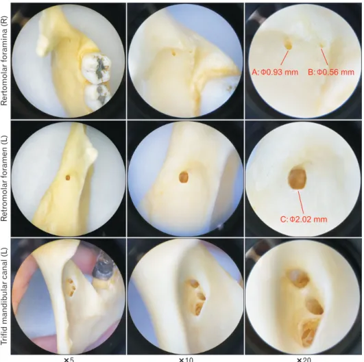 Fig. 3. A closer look at the retromolar  foramina under the surgical microscope  with ×5, ×10, ×20 magnified view  documenting their diameter