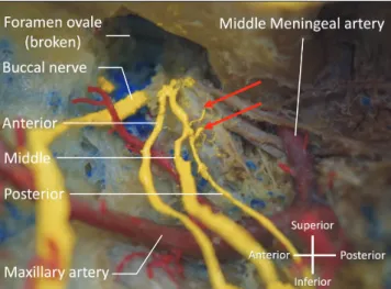 Fig. 2. A magnified image adjacent to the foramen ovale. Note the  two small branches from the ganglion-like structure (arrows).