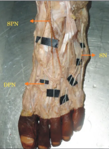 Fig. 4. Deep peroneal nerve (DPN) communicates with the medial  divi sion of superficial peroneal nerve (SPN) by communicating branch  (CB) supplies first interdigital cleft